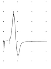 L'électromyogramme (EMG) - Dr Garrigues Neurologue EMG - Arles (13200)